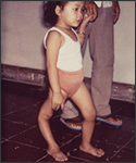 This child is displaying a deformity of her right lower extremity due to polio caused by the poliovirus, an enterovirus member.