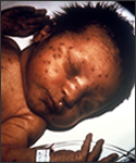 This infant presented with "blueberry muffin" skin lesions indicative of congenital rubella.
