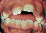 Photo showing malocclusion of the teeth