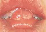 Photo of mouth showing tooth eruption