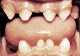 Photo of mouth exhibiting tooth anomalies