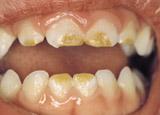 Photo of developmental defects in the mouth