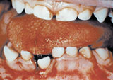 Photo of mouth with oral trauma
