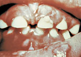Photo of viral infection in the mouth