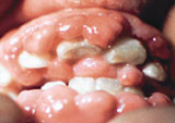 Photo of a mouth with gingival overgrowth