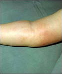 Haemophilus influenzae type b. Cellulitis of the arm proven by blood culture