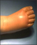 Haemophilus influenzae type b. Cellulitis of the foot proven by blood culture