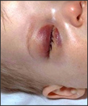 Periorbital cellulitis with purulent exudate from which Streptococcus pneumoniae and Haemophilus influenzae type b were grown on culture