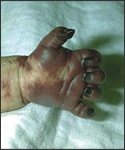 Infant with severe vasculitis with disseminated intravascular coagulation (DIC) with gangrene of the hand secondary to Hib septicemia