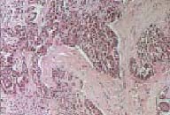 Imagen microscópica de células de mesotelioma