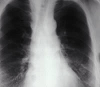 Asbestosis Chest X-ray