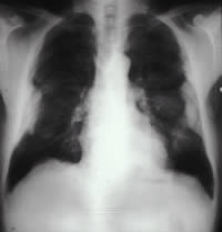 Plaques Chest X-ray