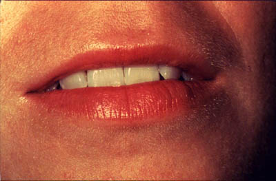 Photograph of examination of the lips