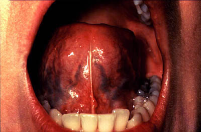 Photograph of examination of ventral surface of tongue