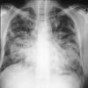 Kaposi sarcoma, pulmonary: chest X ray