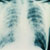 Kaposi sarcoma: chest X ray showing pulmonary involvement