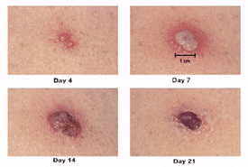 Photographs of the vaccination site at day 4, day 7, day 14, and day 21 after vaccination. Click to view enlarged images.