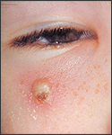 This is an image of a girl with a secondary skin infection on her face due to chickenpox.