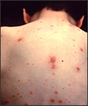This child presented with the characteristic pancorporeal varicella, or “chickenpox” lesions.