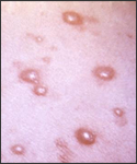 This pustulovesicular rash represents a generalized herpes outbreak due to the Varicella-zoster virus (VZV) pathogen.
