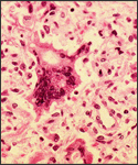 Histopathology of measles pneumonia, (Giant cell).