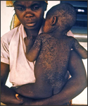 This late 1960s photograph shows a Nigerian mother and her child who was recovering from measles; note that the skin is sloughing on the child as he heals from his measles infection.