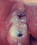 This patient presented on the third pre-eruptive day with “Koplik spots” indicative of the beginning onset of measles.
