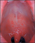 This was a patient who presented with Koplik’s spots on palate due to pre-eruptive measles on day 3 of the illness.