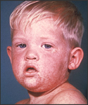 Face of boy with measles, (third day rash).
