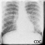Mycoplasm pneumonia can show prominent interstitial opacities, including Kerley B lines.