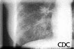 Detail of mycoplasm pneumonia.