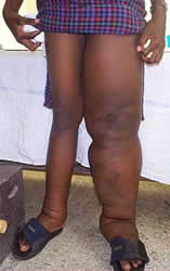 Patient with lymphedema