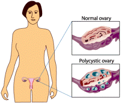 A diagram of the female reproductive system with insets showing a normal ovary and an ovary with cysts.