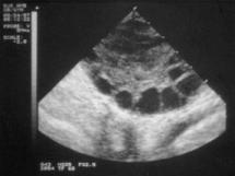 A sonogram of a polycystic ovary.