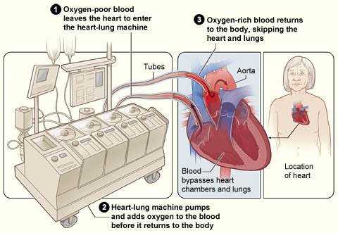 Illustration showing a heart-lung bypass machine attached to a heart during surgery.