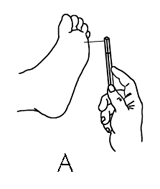 Graphic A - Apply the monofilament perpendicular to the skin’s surface.