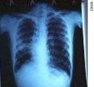 An x-ray of a patient affected by tuberculosis