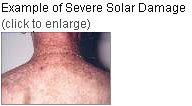 Example of severe solar damage to the shoulders.