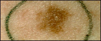 Picture of a dysplastic nevus illustrating irregular shape