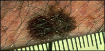 Picture of a melanoma illustrating large size