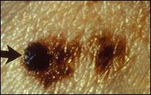 Picture of a melanoma illustrating color variation