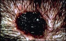 Picture of a melanoma illustrating irregular border