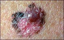 Picture of a melanoma illustrating abnormal surface