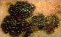 Picture of a very large, irregularly shaped melanoma