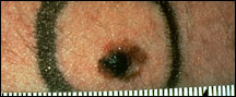 Picture of a mole with abnormal surrounding skin, suggestive of melanoma