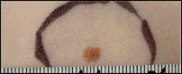 Picture of an ordinary mole illustrating round or oval shape