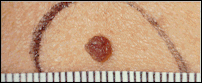 Picture of an ordinary mole illustrating size less than 5 millimeters