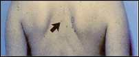 Picture of a man's back illustrating ordinary moles above the waist