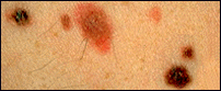 Picture of dysplastic nevi illustrating mixture of tan, brown, and red/pink color