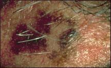 Picture of a melanoma.